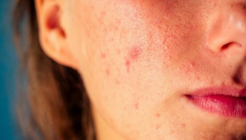 Huile d'argan anti-inflammatoire pour l'acné