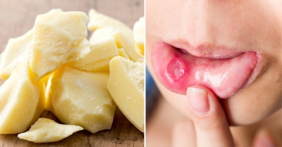 compra il burro di cacao cura l'infiammazione Acquista burro di cacao burro di cacao sano