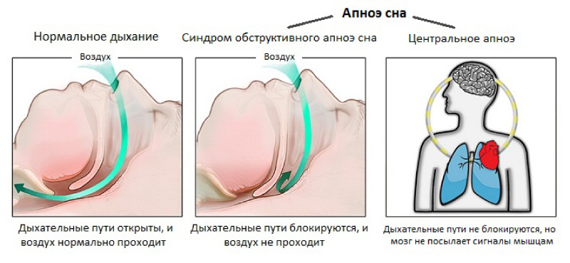 apneu